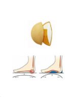 Supinator din Piele Naturală – Susținător Bolta Plantară pentru Picior Plat N125 Supinator din Piele Naturală – Susținător Bolta Plantară pentru Picior Plat N125